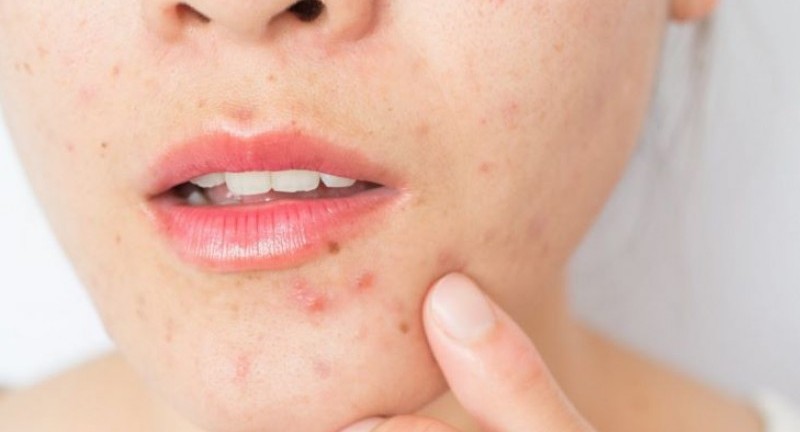 Review Top 10 serum trị mụn tốt nhất nên dùng hiện nay